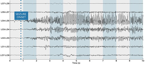 In this image of an EEG scan supplied by Rajeev Agarwal, the onset of the seizure is visibly evident across several channels.