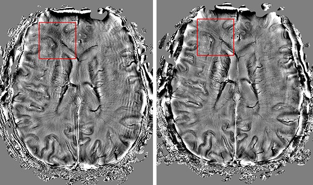 The first scan of a preserve brain (left) has artificially induced movement, so we can clearly see the wave-like effect resulting from motion induced artifacts. In the second image (right), the motion correction technology was turned on. The result is a clear increase in image clarity and visible details.