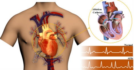 Tactile sensors improve surgical success and patient safety in treating cardiac arrhythmia