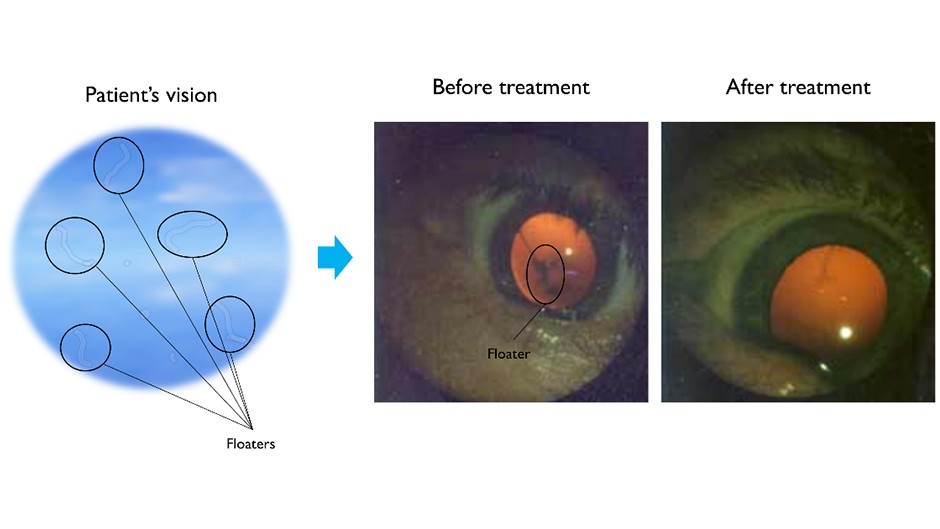  Laser treatment of eye floaters - https://www.eyefloaters.com/eye-floater-types