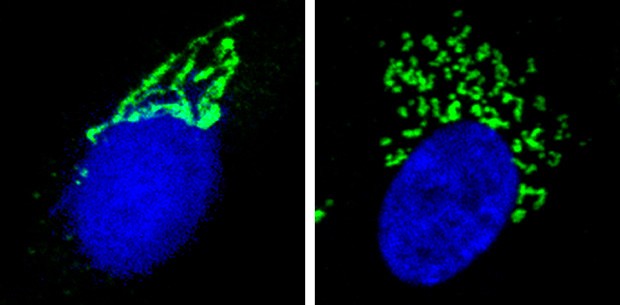 Michael Sacher: “The image on the left is a skin cell from a non-affected individual and the one on the right is from an individual with a mutation in a TRAPP protein. The nucleus is coloured in blue and the Golgi apparatus in green. Note that the Golgi in the affected individual is more fragmented and less organized than that of the non-affected individual.”