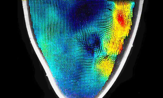 Concordia research examines the blood flow of real patients using 3D-printed models of their heart valves.