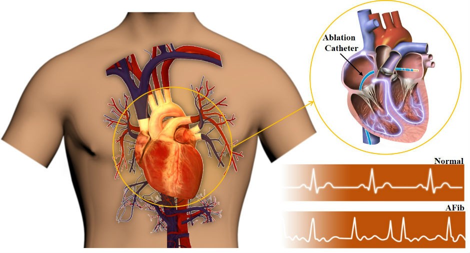 A normal heartbeat versus an AFib heartbeat, along with minimally invasive ablation catheter treatment.