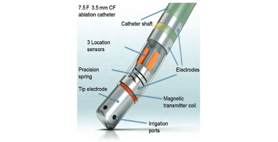 ThermoCool® SmartTouch®, Biosense Webster Inc., CA, US. | Lin et al., Arrhythmia & Electrophysiology Review 2013;3(1):44-7 ThermoCool® SmartTouch®, Biosense Webster Inc., CA, US. | Lin et al., Arrhythmia & Electrophysiology Review 2013;3(1):44-7