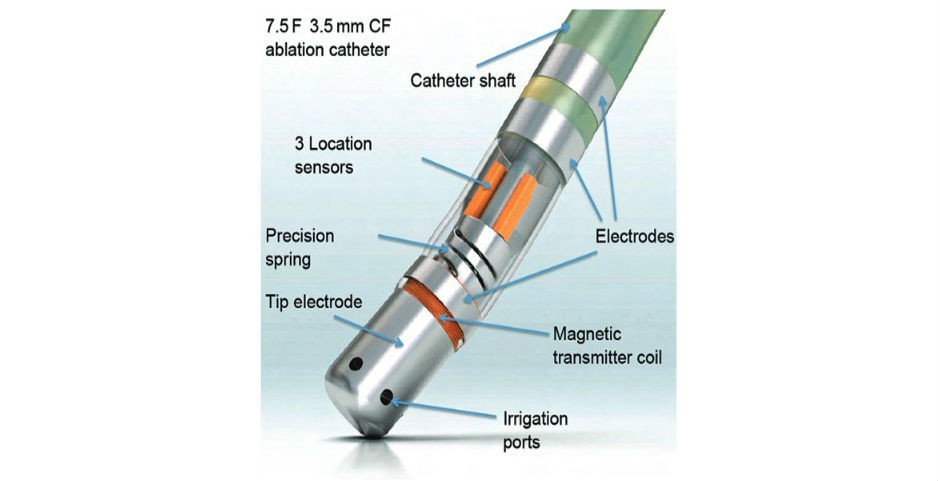 ThermoCool® SmartTouch®, Biosense Webster Inc., CA, US. | Lin et al., Arrhythmia & Electrophysiology Review 2013;3(1):44-7