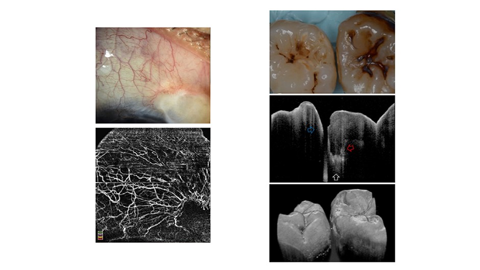 (Left) Optical imaging of corneal vascularization (soft tissue)-Ang et al. 2018 (Right)Optical imaging of teeth-Shimada et al. 2020