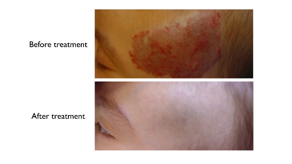 Laser treatment of vascular malformations-Jeremy et al. 2013