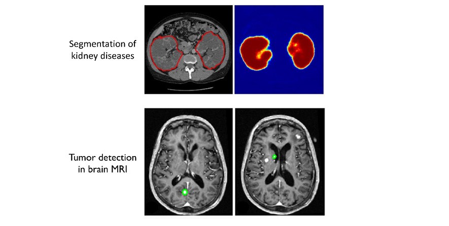 Automatic segmentation of kidney disease (up, Sharma et al. 2017), Brain tumor detection and segmentation in MRI (down, Yu et al. 2014)