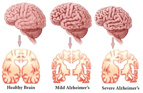 Brain in the progression of Alzheimer’s disease as a comment type of dementia diseases, Verkhratsky et al., Neuroglia in Neurodegenerative Diseases, 2019
